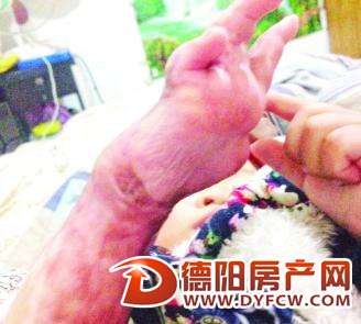 1岁女童被开水烫伤 偏方“治疗”险丧命